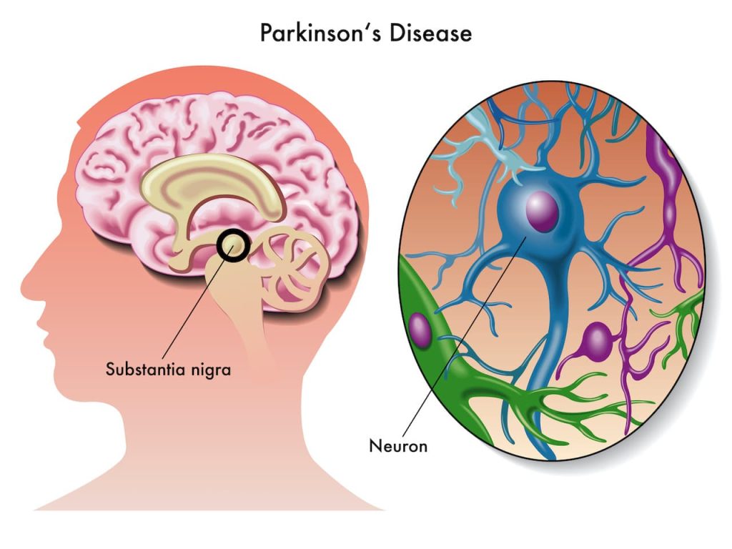 Qué es el Parkinson 1